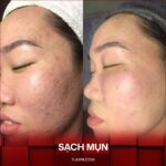 Combo 5 Buổi Chăm Sóc Da Mụn Chuyên Sâu Tại Hệ Thống Queeny Beauty Center - Ảnh 2