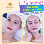 Căng Bóng Không Xâm Lấn - Trị Liệu Tuyết Nhiệt Đới ( Cổ, Mặt, Bàn Tay ) Tại Aquamedi Spa - Ảnh 2