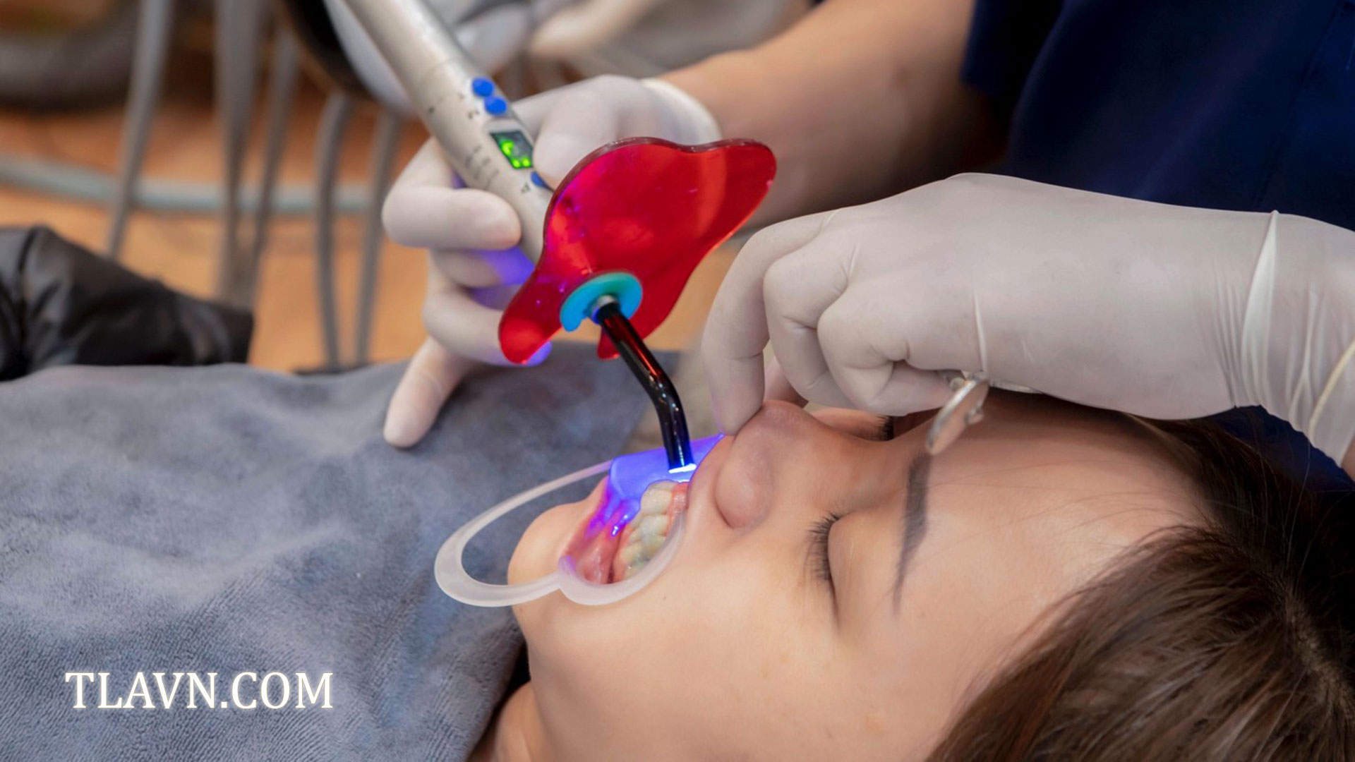 Điều chỉnh lợi, cắt nướu thẩm mỹ tại Nha Khoa Quốc Tế Đông Đô
