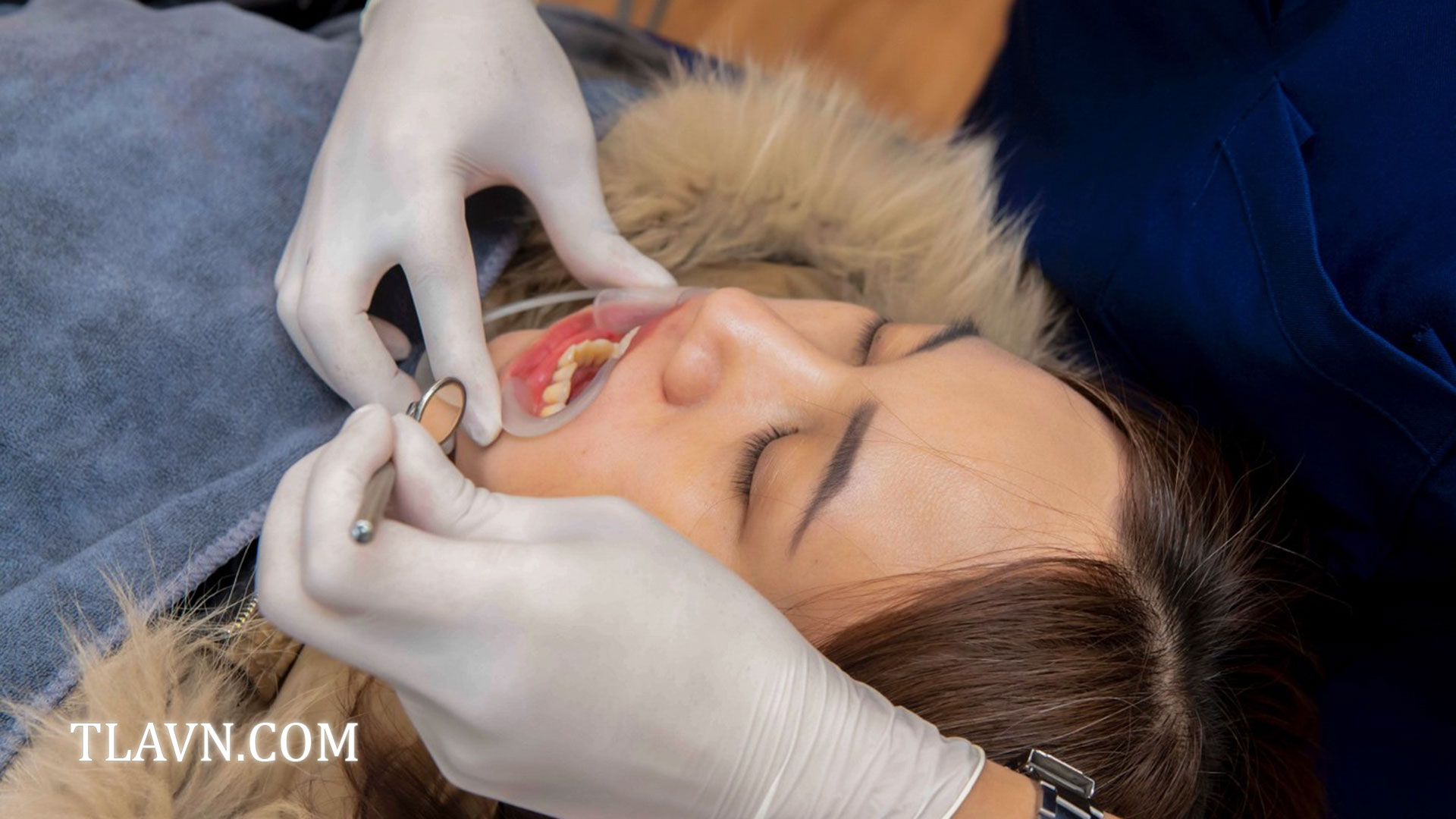 Tẩy trắng răng toàn hàm tại Nha Khoa Quốc Tế Đông Đô