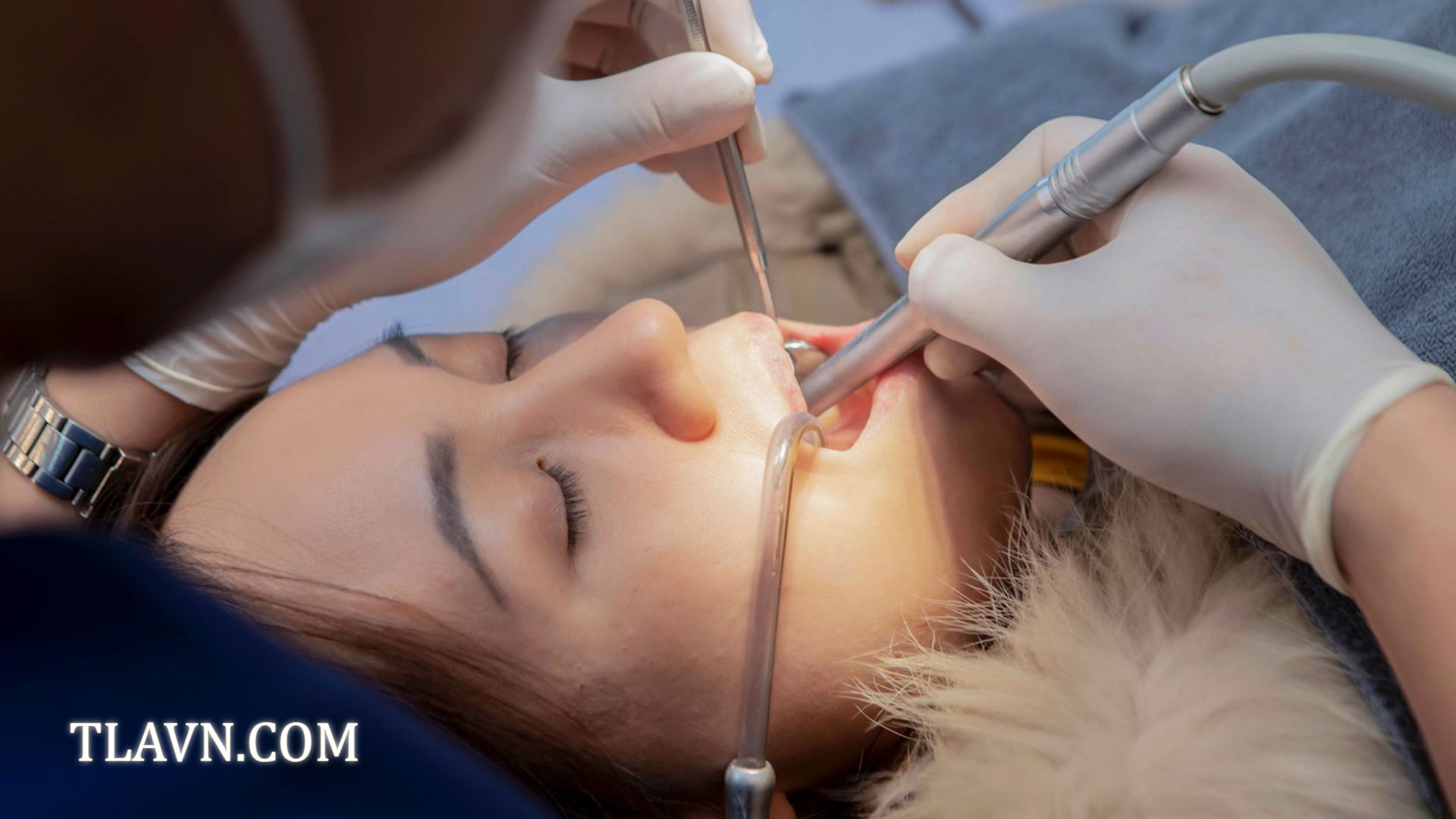 Tẩy trắng răng toàn hàm tại Nha Khoa Quốc Tế Đông Đô