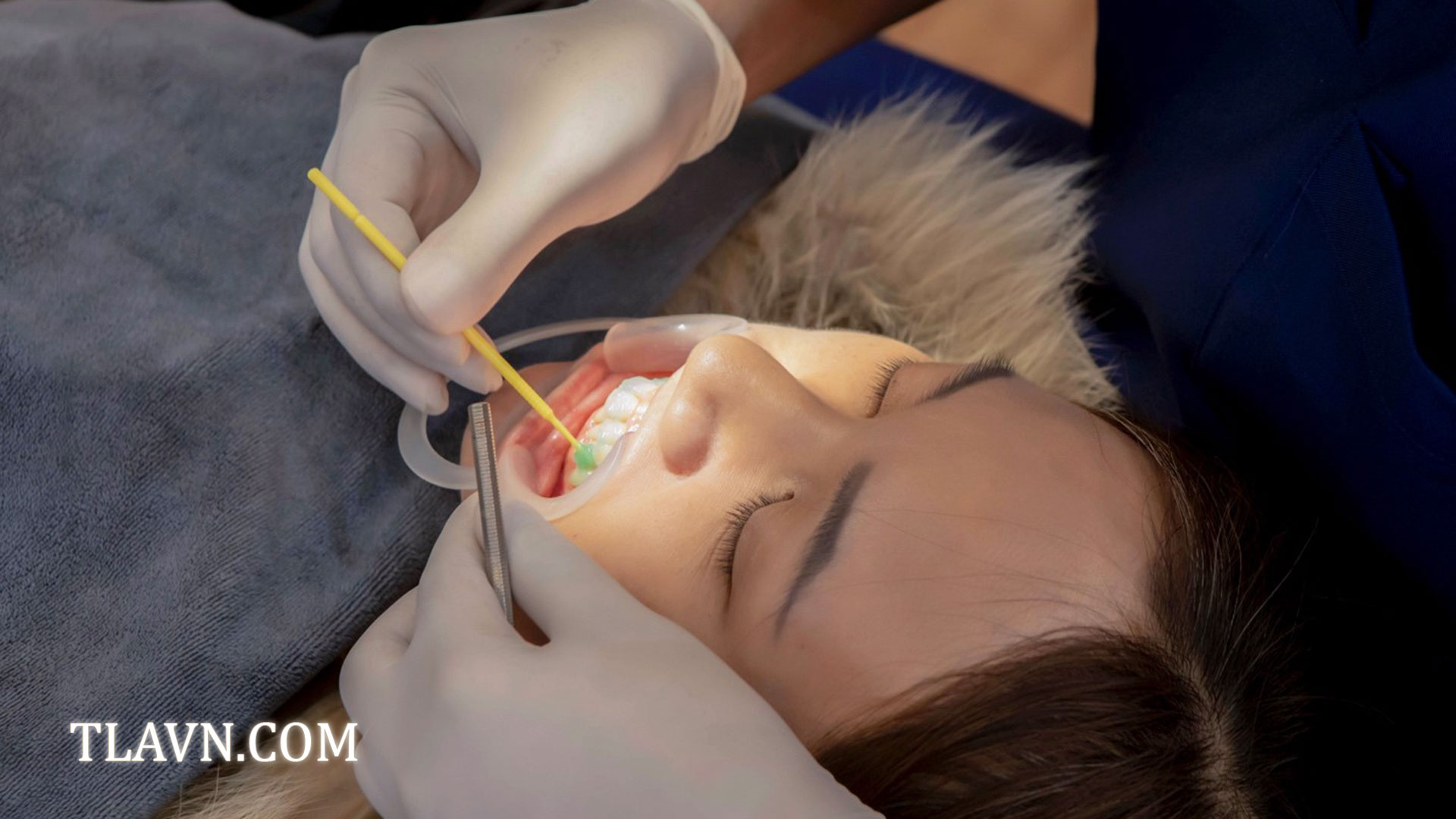 Tẩy trắng răng toàn hàm tại Nha Khoa Quốc Tế Đông Đô