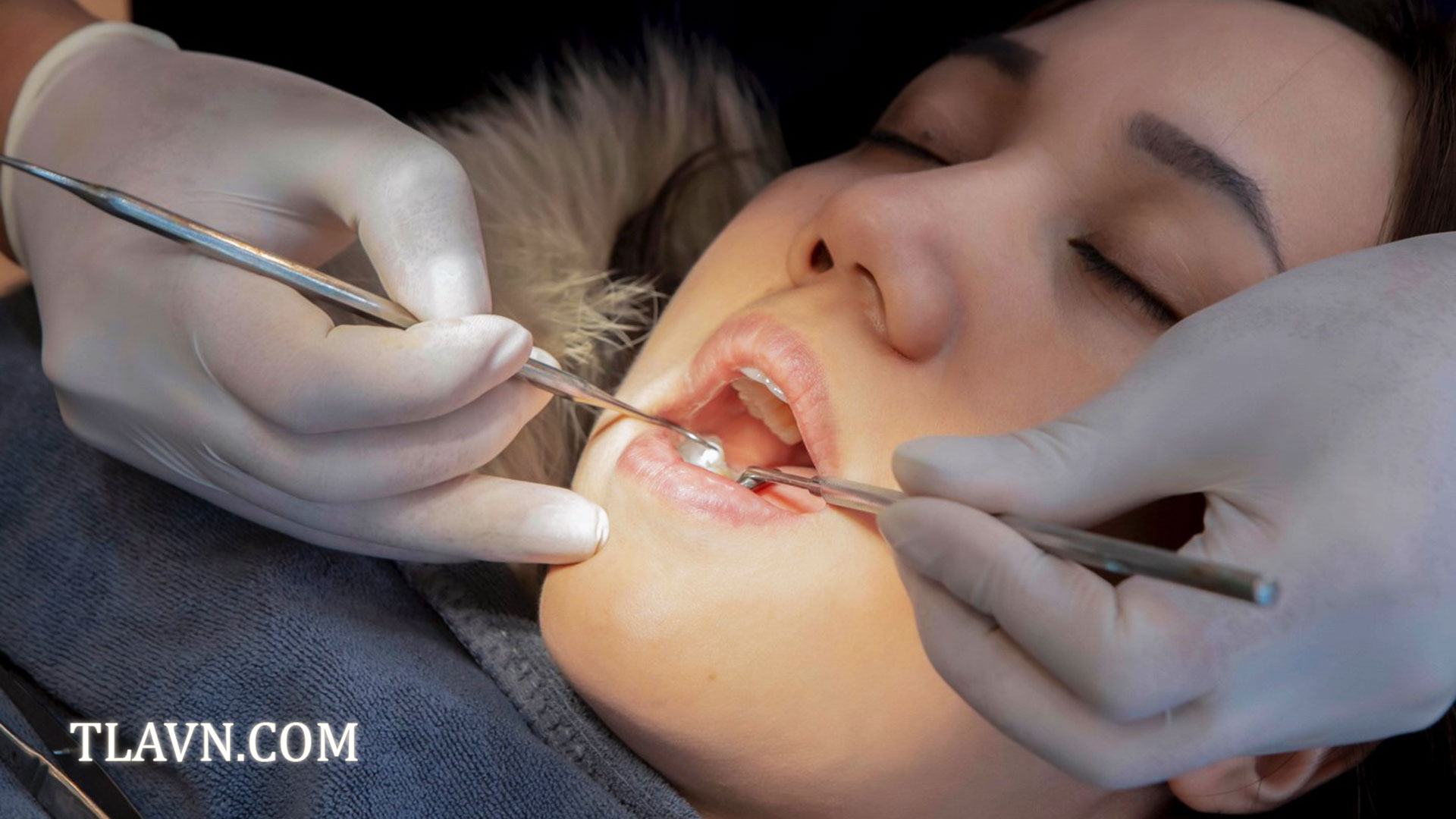 Tẩy trắng răng toàn hàm tại Nha Khoa Quốc Tế Đông Đô