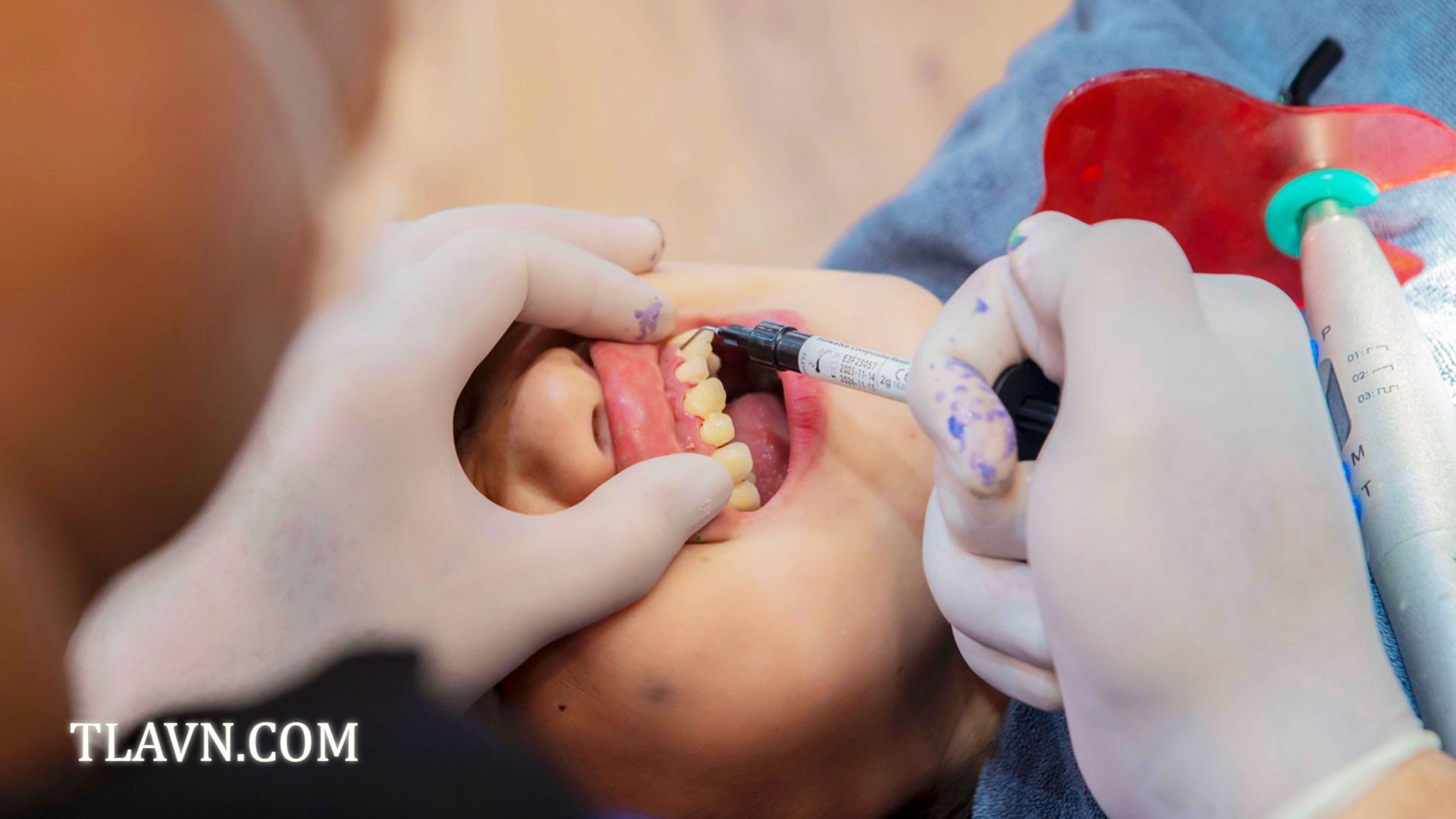 Nhổ Răng Khôn Số 8 Tại Nha Khoa Quốc Tế Đông Đô