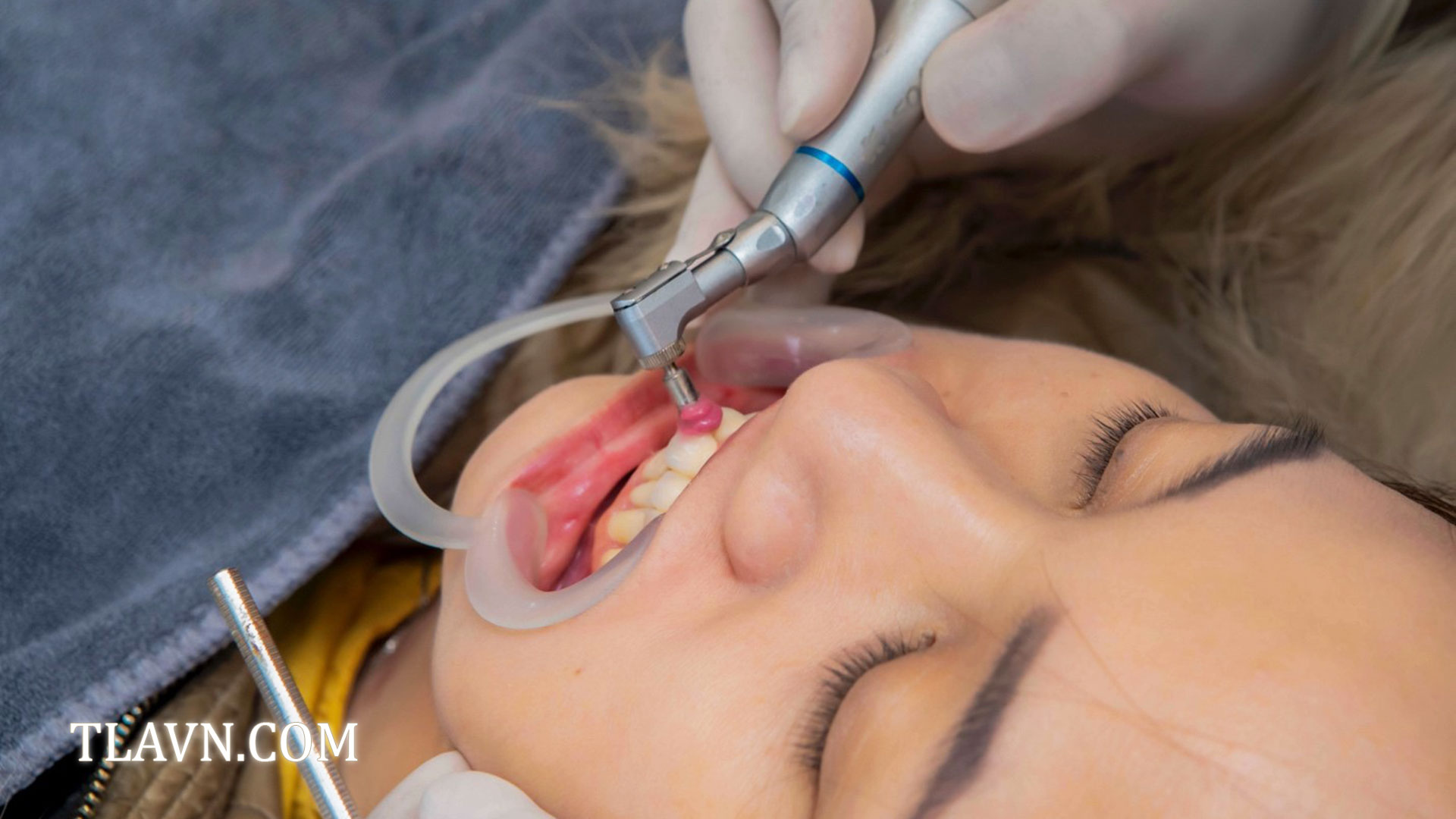 Tẩy trắng răng toàn hàm tại Nha Khoa Quốc Tế Đông Đô