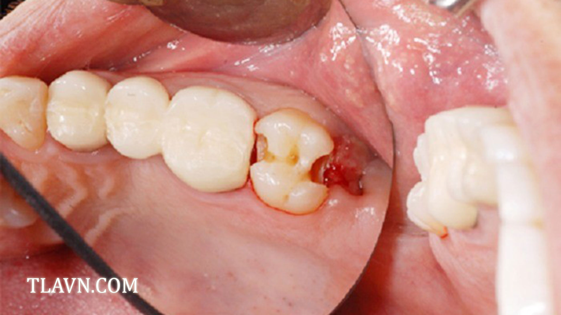 Nhổ Răng Khôn Số 8 Tại Nha Khoa Quốc Tế Đông Đô