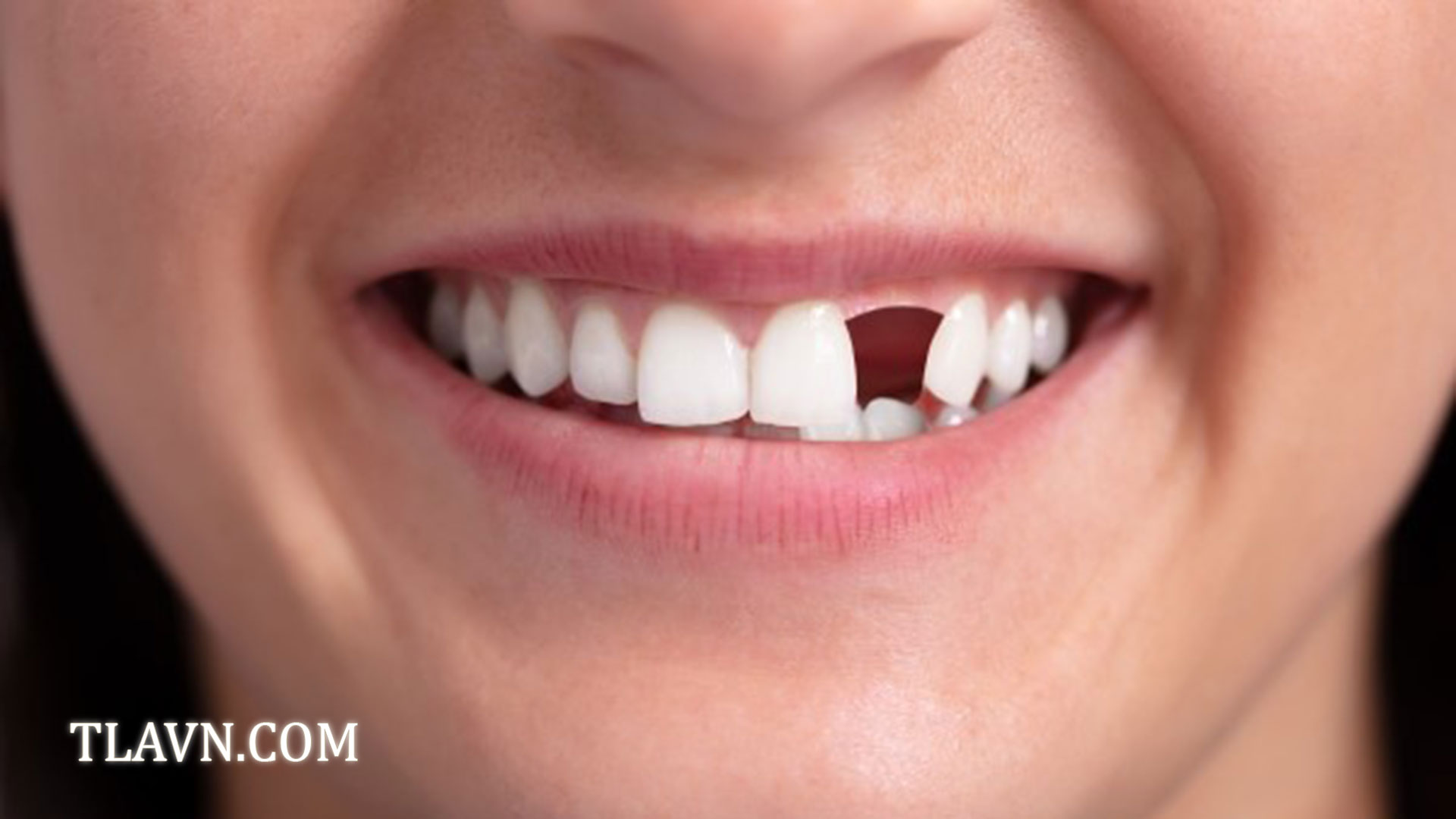 Cắm Trụ Implant Thẩm Mỹ tại Nha Khoa Quốc Tế Đông Đô