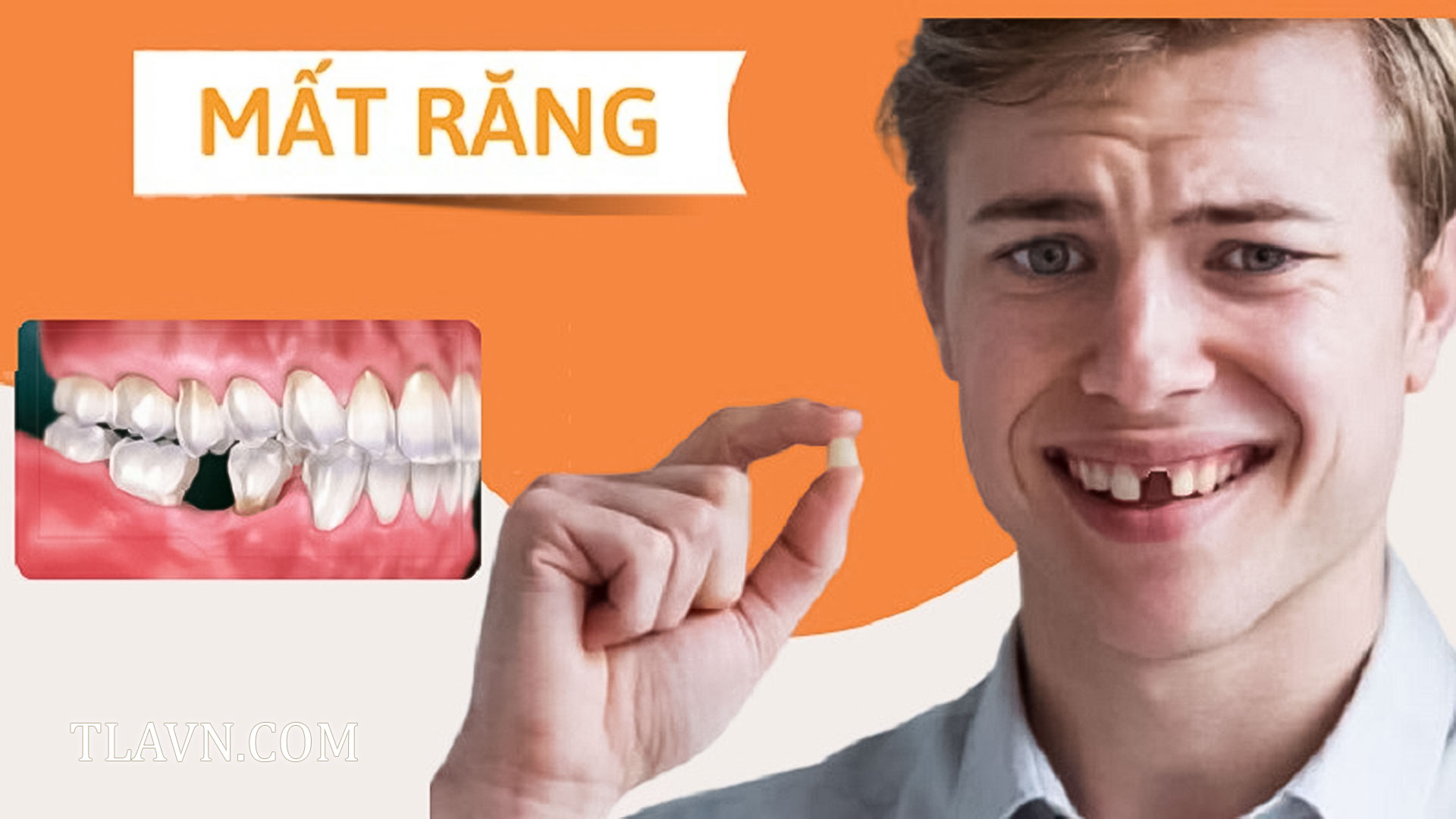 Cắm Trụ Implant Thẩm Mỹ tại Nha Khoa Quốc Tế Đông Đô