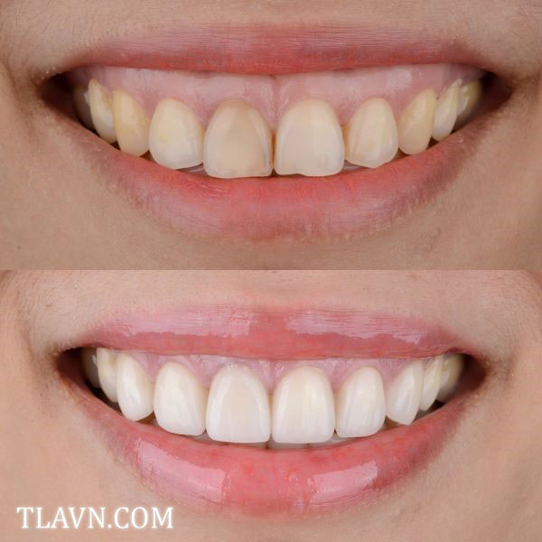 Điều chỉnh lợi, cắt nướu thẩm mỹ tại Nha Khoa Quốc Tế Đông Đô