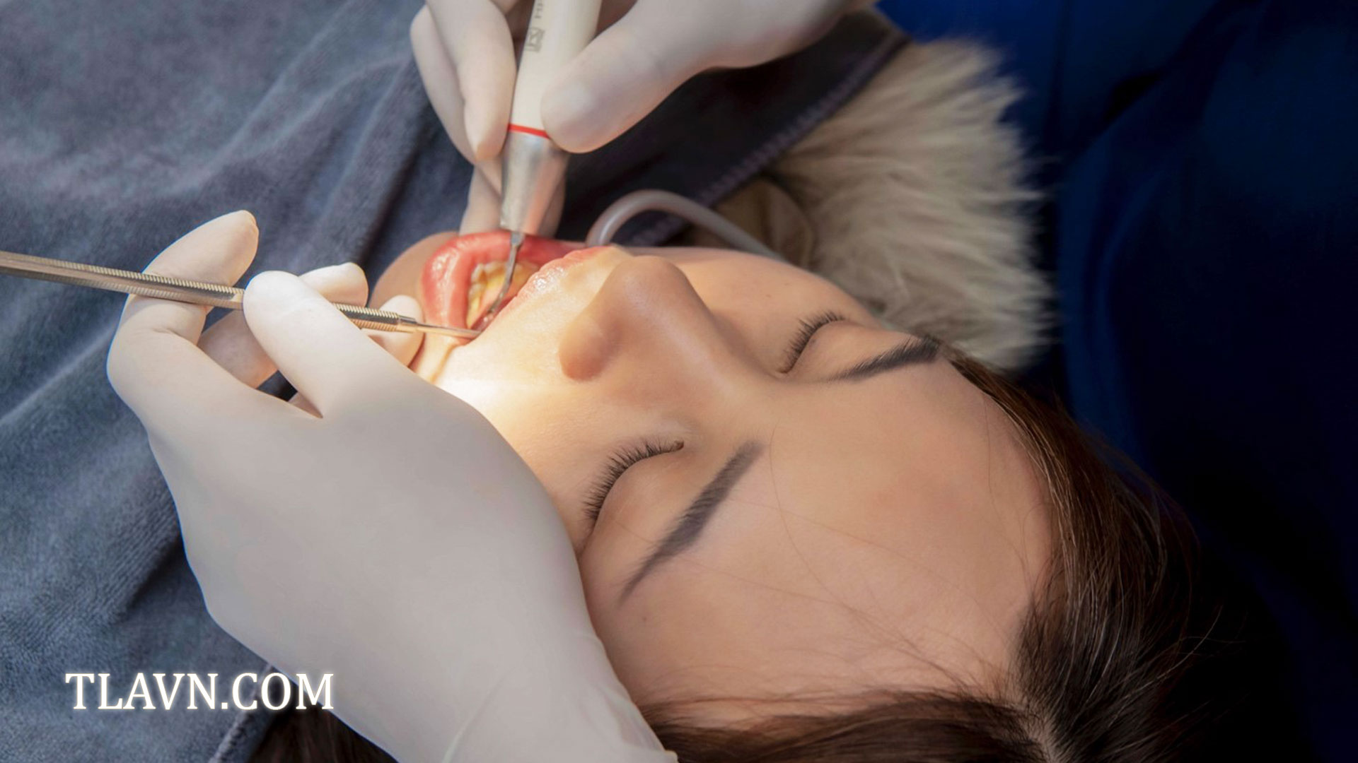 Nhổ Răng Khôn Số 8 Tại Nha Khoa Quốc Tế Đông Đô