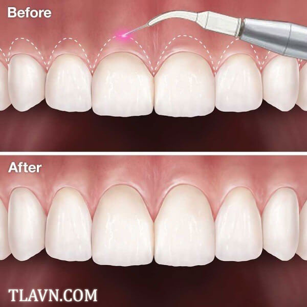 Điều chỉnh lợi, cắt nướu thẩm mỹ tại Nha Khoa Quốc Tế Đông Đô
