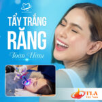 Tẩy trắng răng toàn hàm tại Nha Khoa Quốc Tế Đông Đô