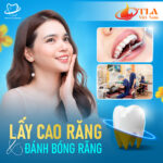 Lấy cao răng, đánh bóng răng tại nha khoa Quốc tế Đông Đô